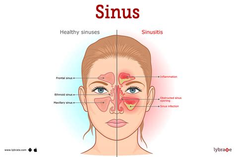 SINUS.